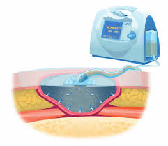 From the south, take exit 567a towards hildebrand ave and merge onto frontage road. Schematic Diagram Of Vac Therapy Vac Npwt Kci San Antonio Tx Download Scientific Diagram