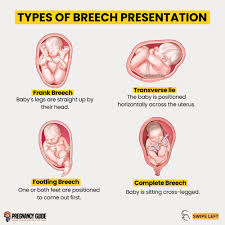 Image result for Breech Presentation