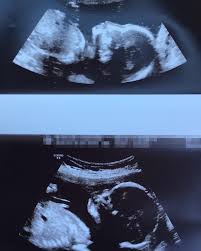 What Doctors Spotted on the Ultrasound Left Them Speechless — And This Baby  Girl Captivated Everyone from the Moment She Was Born 👶🩷✨ When  29-year-old Emily Foster from Kent, England 🇬🇧, walked