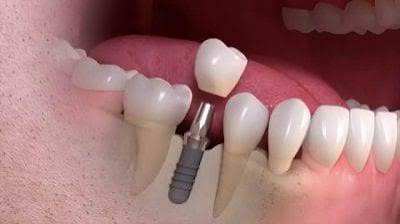implant istanbul