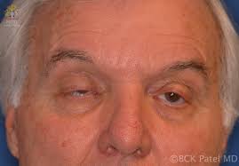 There is increasing evidence of a connection between hearing function and myasthenia gravis (mg). Ptosis In Myasthenia Gravis Patel Plastic Surgery