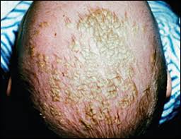 Seboreik dermatit kızarıklık şeklinde ortaya çıkan, cilde yağlı ve pullu bir görünüm veren bir cilt hastalığıdır. Seboreik Dermatit Ve Sac Dokulmesi Sebore