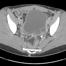 Endometriosis affects an estimated 176 million women worldwide regardless of their ethnic and many remain undiagnosed and are therefore not treated. Endometriosis With Hematosalpinx Body Mr Case Studies Ctisus Ct Scanning