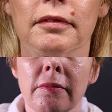Dip scissors and tweezers in rubbing alcohol to disinfect them. Mole Removal Radiowave Rf Treatment Melbourne