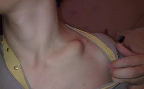 Доброкачественные, предраковые по основной классификации новообразования кожи делятся на доброкачественные и еще такие клетки медленно растут, могут давить на соседние ткани, но никогда в них не проникают. Promezh Grudej Shishka Chto Delat Shishka V Grudi Chto Eto Mozhet Byt Malenkaya Shishka Mezhdu Kostmi Na Grudnoj Kletke