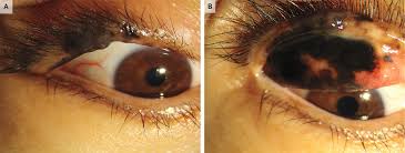 Image result for conjunctival melanoma