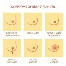 Thickening or swelling of part of the breast. Breast Cancer Symptoms Complications And Treatment