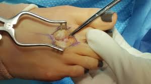 Neuropathy is chiefly due to compression and irritation at the plantar aspect of the transverse intermetatarsal ligament. Morton S Neuroma In The Foot As Seen On Mri Youtube