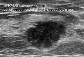 Check spelling or type a new query. Breast Mammogram Shows Mass What To Do Next