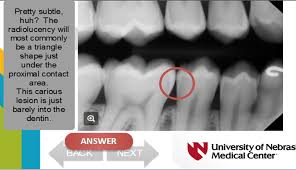 The differences in enamel caries scores between the immunised group and the control group showed a 50 at the end of the trial, the extent of enamel caries lesions in the first, second, and third molar. Radiographic Diagnosis Of Dental Caries E Gallery