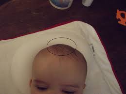 Anterior Fontanelle Bulging Beyond Achondroplasia