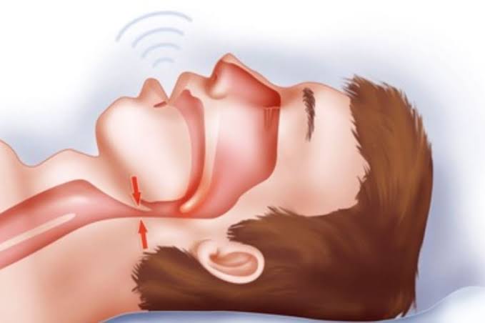 Hội chứng ngưng thở khi ngủ: Biện pháp nào để điều trị hiệu quả?