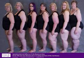 Hvis det oppstår blåmerker på beina, kan dette tyde på at kroppen har en åreknussykdom. En Storrelse For Stor Heidirosander Paereform Og Det Hersens Fettet