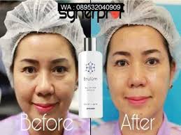 Cara Menghilangkan Flek Hitam Bekas Jerawat Wa 0895 3209 04610 Jerawat Wajah Anti Penuaan