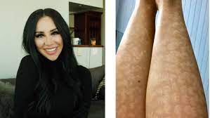 6655 main street, vancouver, british columbia. Vancouver Woman Suing After Painful Laser Hair Removal Leaves Her Scarred Cbc News