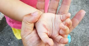 Usually there are no blisters. Treating Burns What To Do If Your Child Gets Burned Ask Dr Sears