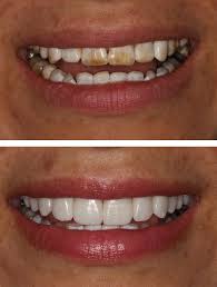 Some of your enamel is removed and replaced with an advanced dental ceramic that looks and performs like regular tooth enamel. Porcelain Veneers Minneapolis Gorman Center For Fine Dentistry
