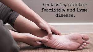 Dr Daniel Cameron Feet Pain Plantar Fasciitis And Lyme Disease Facebook