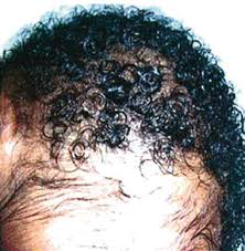 What's the best way to make your hair silky? Diseases That Turn African Hair Silky Ajose 2012 International Journal Of Dermatology Wiley Online Library