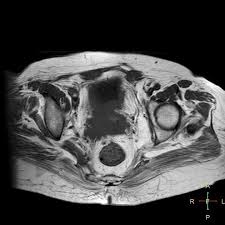 A total hysterectomy is the most common treatment for women with stage 1 cervical cancer who do not it is also used after surgery if there are cancer cells in or close to the edges of the removed tissue, in blood vessels or lymph vessels in the removed. Cervical Stump Squamous Cell Carcinoma Radiology Case Radiopaedia Org