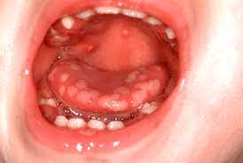 Herpes simplex virus infections may be caused by two virus genotypes: Clinical Practice Guidelines Hsv Gingivostomatitis