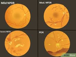 Diabetic retinopathy is characterized by damage in the blood vessel of the retina or the light sensitive tissue found at the rear of the eye. How To Treat Diabetic Retinopathy 8 Steps With Pictures