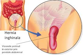 We did not find results for: Hernia Inghinala