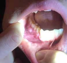 Mit einer wurzelbehandlung (wurzelkanalbehandlung) kann man eigene zähne länger erhalten. Blaschen Nach Wurzelbehandlung Gesundheit Medizin Zahne