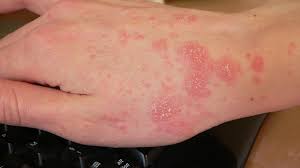 Image result for scabies human symptoms