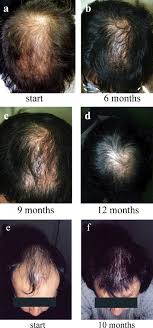However, their application is known to be cumbersome and. Hair Loss Forum Vellus Hairs And Donora Area Hairs Equal When Transplanted To Mice