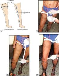 Image result for Perthes Test