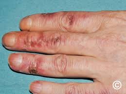 Image result for Chilblains
