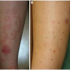 Purpura are nonblanchable, hemorrhagic skin lesions that result from the leakage of red blood cells into the skin. The Cutaneous Manifestations Of Henoch Schonlein Purpura In Our Download Scientific Diagram