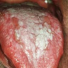 Image result for lichen planus on tongue)