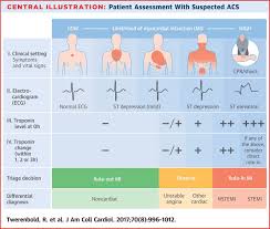 Image Result For Lead Chart For Myocardial Infarction