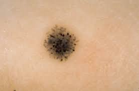 Image result for Spitz Nevus