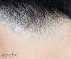 Image result for Tinea Capitis
