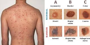 Selain itu, tahi lalat di bahagian pipi juga membawa maksud anda mempunyai kawan yang ramai meskipun anda adalah seorang pemalu. Jangan Abai Jika Tahi Lalat Tumbuh Tiba Tiba Di Anggota Badan Ia Mungkin Kanser Kulit Remaja