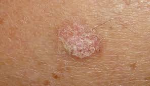 A doctor who uses surgery to treat cancer a medical oncologist: 10 Signs And Symptoms Of Skin Cancer Lifeberrys Com