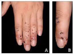 This sub feels a lot better with all the paper hands gone. Granulomatous Reaction After Cholla Cactus Spine Injury Mdedge Dermatology