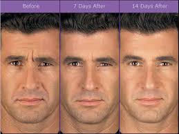 One result can be that your face appears frozen or immobile, which can look highly unnatural. Botox Kind Dermatology And Medical Spa Santa Barbara Ca