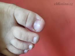 Image result for Akutní zánět nehtového lůžka