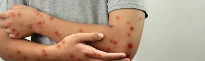 Image result for Monkeypox