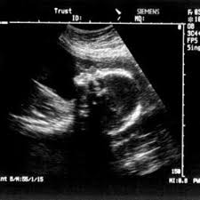 Das gewicht deines kindes ist von verschiedenen faktoren, wie körpergröße, geschlecht, ernährung und bewegungsverhalten, abhängig. á 21 Ssw Schwangerschaftswoche Alle Infos Grosse Entwicklung