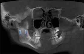 Image result for Coronoid Process Fracture