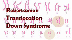 Mar 30, 2021 · robertsonian translocation and isochromosome or ring chromosome are the other 2 possible causes of trisomy 21. Robertsonian Translocation Down Syndrome Rob Youtube