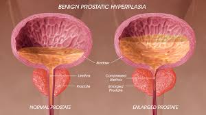 The most common symptom of bph includes having to urinate more, often at night. Benign Prostatic Hyperplasia Symptoms Causes And Treatment Scientific Animations