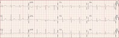 Lea el pdf de electrocardiografia basica: Como Interpretar Un Electrocardiograma El Blog De Girodmedical Magento Title
