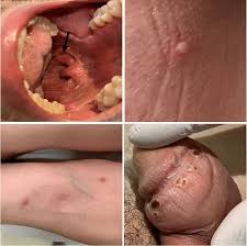 Image result for Pustule