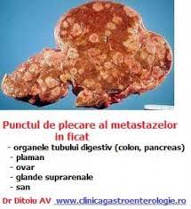 El cáncer de colon y recto se produce en el revestimiento del intestino grueso. Metastazele In Ficat Sunt Frecvente Cabinet De Gastroenterologie Si Hepatologie Bucuresti 0758 751 841